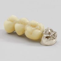 Dental-Crown